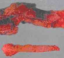 Pancreatită necrozantă hemoragică și formă acută