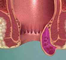 Tromboză hemoroidală: stadiu, simptome si tratamente