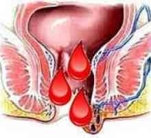 Hemoroizi în timpul menstruației, de ce este exacerbată în fața lor?