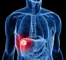 Carcinomul hepatocelular ficatului: simptome, tratament, prognostic, diagnostic