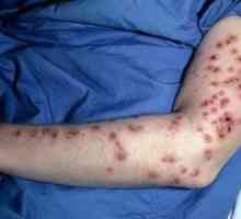 Eczema herpetică: semne, simptome, tratament