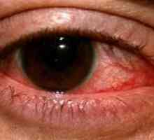 Herpetic cheratită ochi: tratament, prevenire, simptome, cauze
