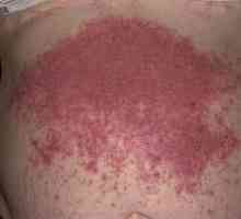 Dermatita herpetiforma: simptome, tratament