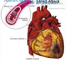 Infarct miocardic. Cauzele de deces în infarct miocardic