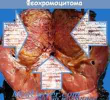 Hiperfuncția medulosuprarenalei (feocromocitomul) morfologia și anatomia patologică