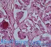 Hyperparathyroid osteodistrofie fibros generalizată (boala von Recklinghausen) morfologie, anatomie…