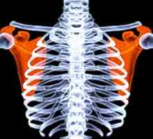 Osteodystrophy Hyperparathyroid: tratament