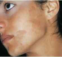 Hiperpigmentarea pielii: tratament, cauze, prevenire