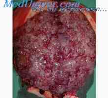 Gipertonus retroplatsentarnoy miometru și fibrom uterin. placentei creștere