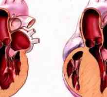 Cardiomiopatie hipertrofică: Tratament, Simptome