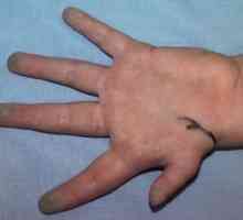 Hipoplazia primele degete