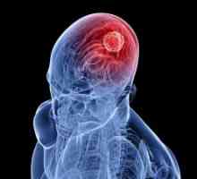 Gliom cerebral: tratament, prognostic, simptome, semne