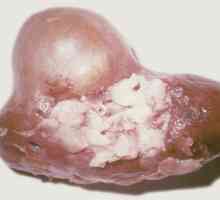 Viermi în rinichi uman, simptomele de viermi în ele