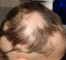 Alopecia areata: Tratament, cauze, simptome