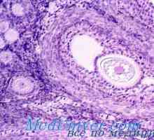 Gormonalnoaktivnye tumori ovariene. Follikuloma