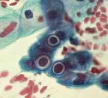 Infecția cu chlamydia: tratament, simptome, semne, diagnostic, cauze