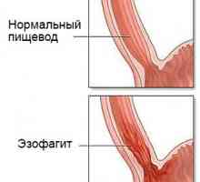 Simptomele cronice distadlny esofagita si tratament