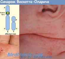 Aldrich - sindromul imunodeficienței Wiskott cu eczeme. Boala granulomatoasă cronică