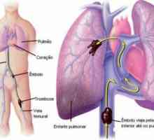 Pulmonare infarct miocardic, tratament, simptome, consecințe