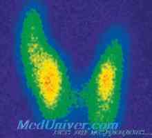 Infarct miocardic cu gușă toxică. tractului gastrointestinal, rinichi, glanda suprarenală cu gușă