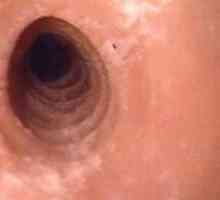 Infecție (herpetică) esofagită