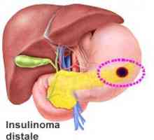 Insulinom pancreasului