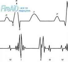 Zgomote cardiace. Primul (sistolică) inima de sunet. A doua (diastolică) inima de sunet.…