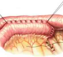 Schimbarea anatomia tractului gastro-intestinal, ca urmare a intervenției chirurgicale. anastomoză
