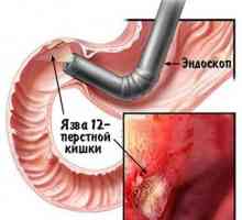 Ulcer 12 ulcer duodenal: operația de recuperare și de la ea