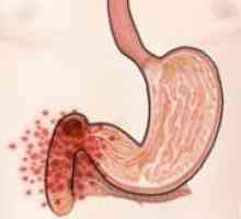 Ulcerele becuri 12 ulcer duodenal sau ulcer cicatricial tulpina