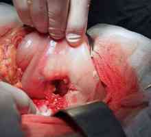 Explozie ulcer gastric, primele semne de ruptură, cauzele și consecințele