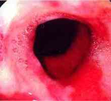 Esofagita ulcerativa a esofagului