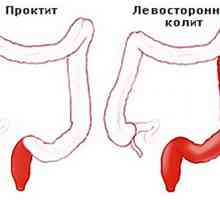 Colita ulceroasă este o formă de distal
