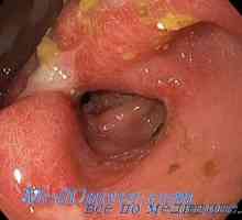 Kvaterona Eficienta in boala ulcer peptic. Mucoasa stomacului sub influența anticolinergice