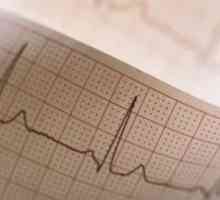 Instabilitatea miocardic electric: tratament, cauze, simptome, semne
