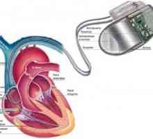 Stimulator cardiac implantabil