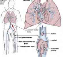 Embolism si tromboza arterelor, tratament