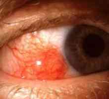 Episcleritis ochi: tratament, simptome, cauze