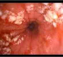 Fibrinous esofagita eroziva si tratamentul acesteia