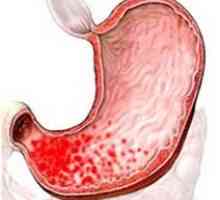 Eroziv catarală cronică focală gastrită superficială