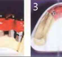 Etapele de fabricare a unei proteze dentare fixe mandibulă. Etapele 6 aprilie
