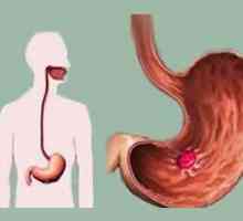 Etiologia si patogeneza ulcerului gastric