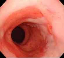 Esofagita treimea inferioară a esofagului