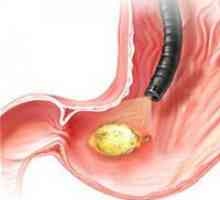 Cum de a evita repetarea bolii de ulcer peptic? Prevenirea ulcerului duodenal