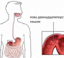 Care sunt simptomele de ulcer duodenal, simptomele de ulcer peptic?
