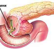 Pietrele (calculi) in pancreas si simptomele de tratament (chirurgie, îndepărtarea)
