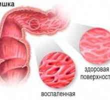 Colită intestinală catarală