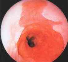 Catarală (suprafață) esofagitei treime inferioara a esofagului