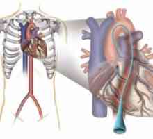 Cateterism cardiac
