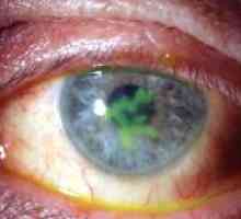 Ochi cheratită: tratament, simptome, cauze, simptome